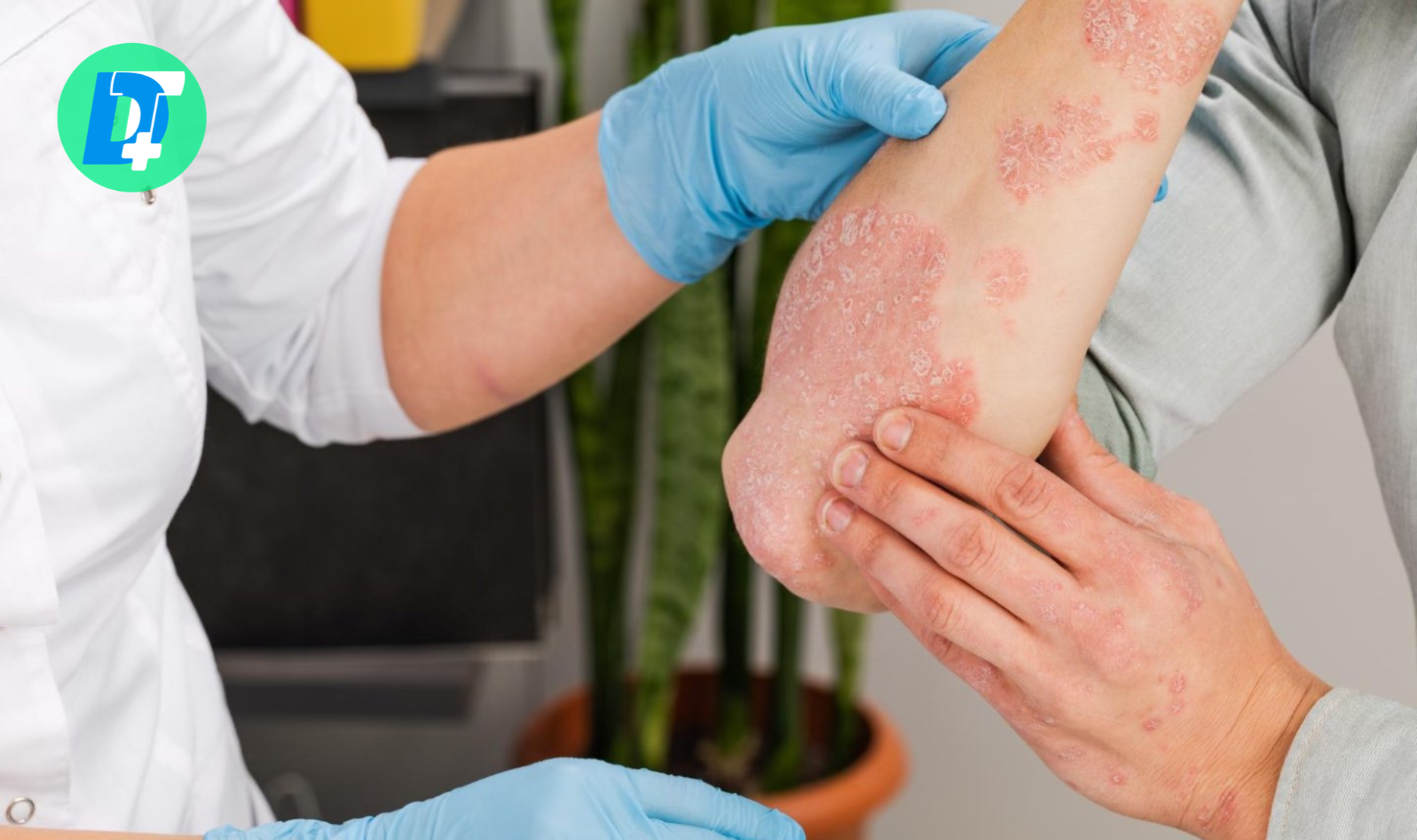 Psoriazis – cauze, simptome și opțiuni de tratament