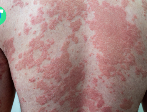 De ce îți distruge psoriazisul pielea?