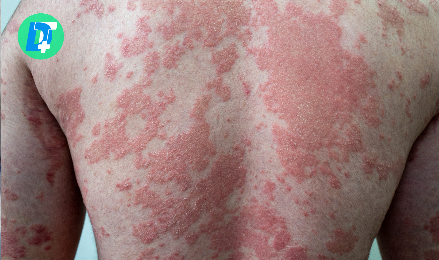 Află ce este psoriazisul, care sunt cauzele și simptomele sale, ce factori declanșează puseele și ce opțiuni moderne de tratament există.